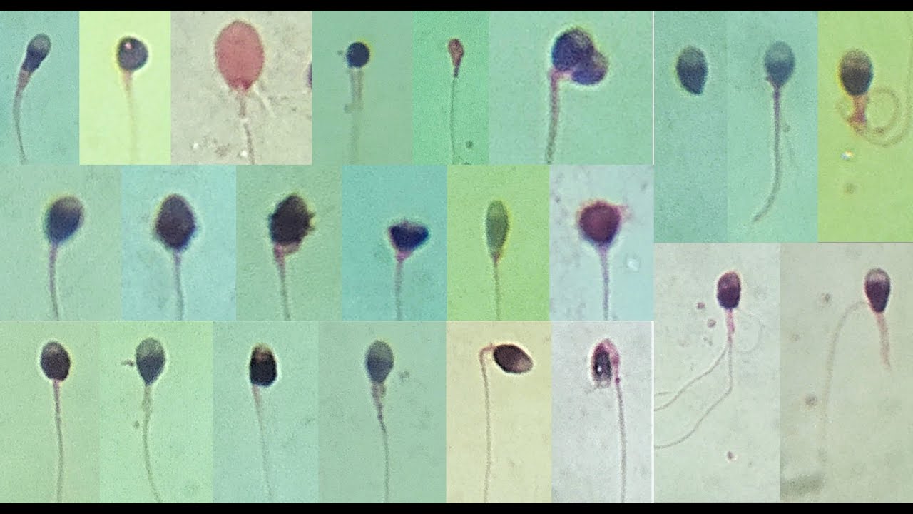 Semen Analysis Test Lab | Sperm Morphology