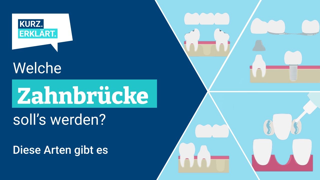 Zahnbr&uuml;cken: Alles, was Du zu den Arten wissen musst - kurz erkl&auml;rt!