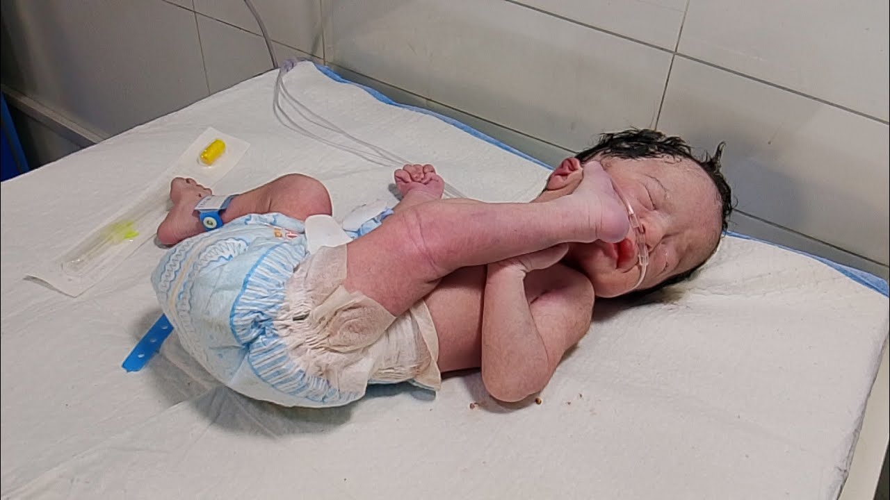 Anomalous Baby NICU Care &ndash; IV Cannula | Long Video Caption