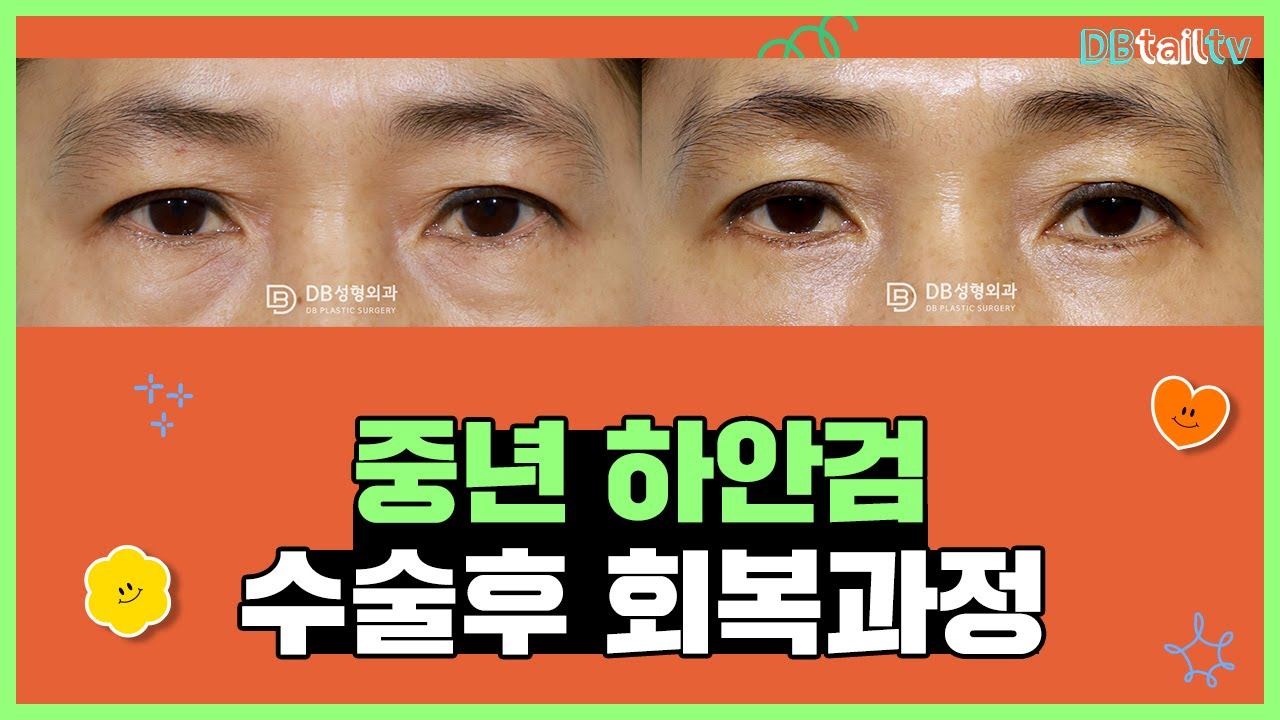 중년 하안검 수술후 회복과정