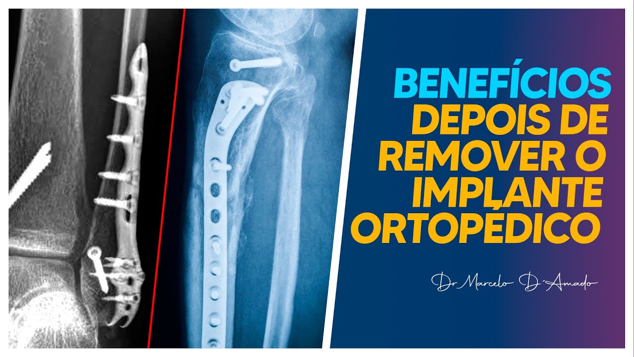 APÓS UMA CIRURGIA COM PLACA ORTOPÉDICA, SURGE A DÚVIDA: MANTER OU REMOVER? QUAL OS BENEFÍCIOS?