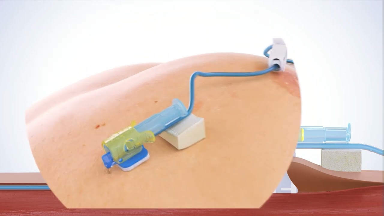 PPS CT Huber Needle &ndash; One-handed safety needle activation