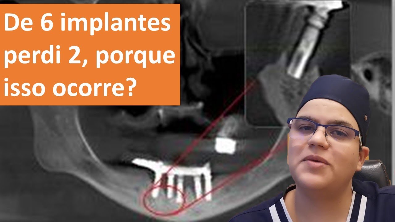 De 6 implantes perdi 2 como isso é possível?| Dra Bianca Rosa | Clínica Bianca Rosa