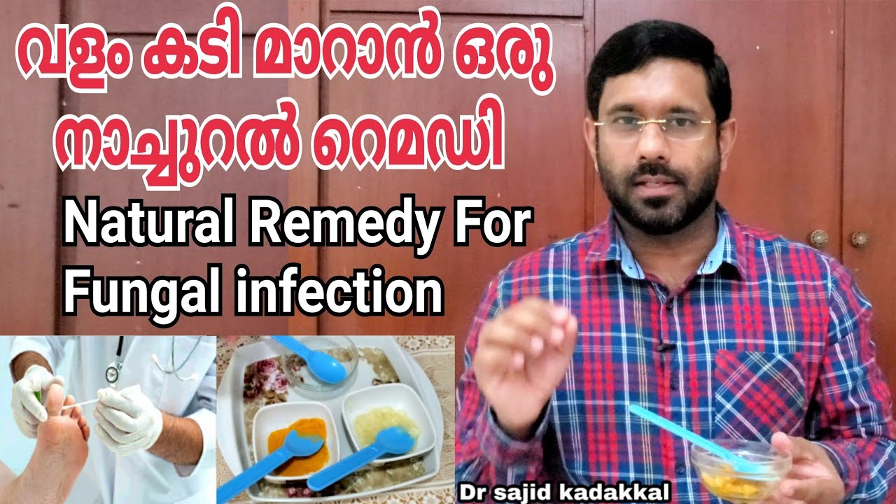 Natural Remedy For Fungal infection, കാലിലെ വളം കടി മാറാൻ ഒരു പ്രകൃതിദത്ത മരുന്ന്. Feet Fungus