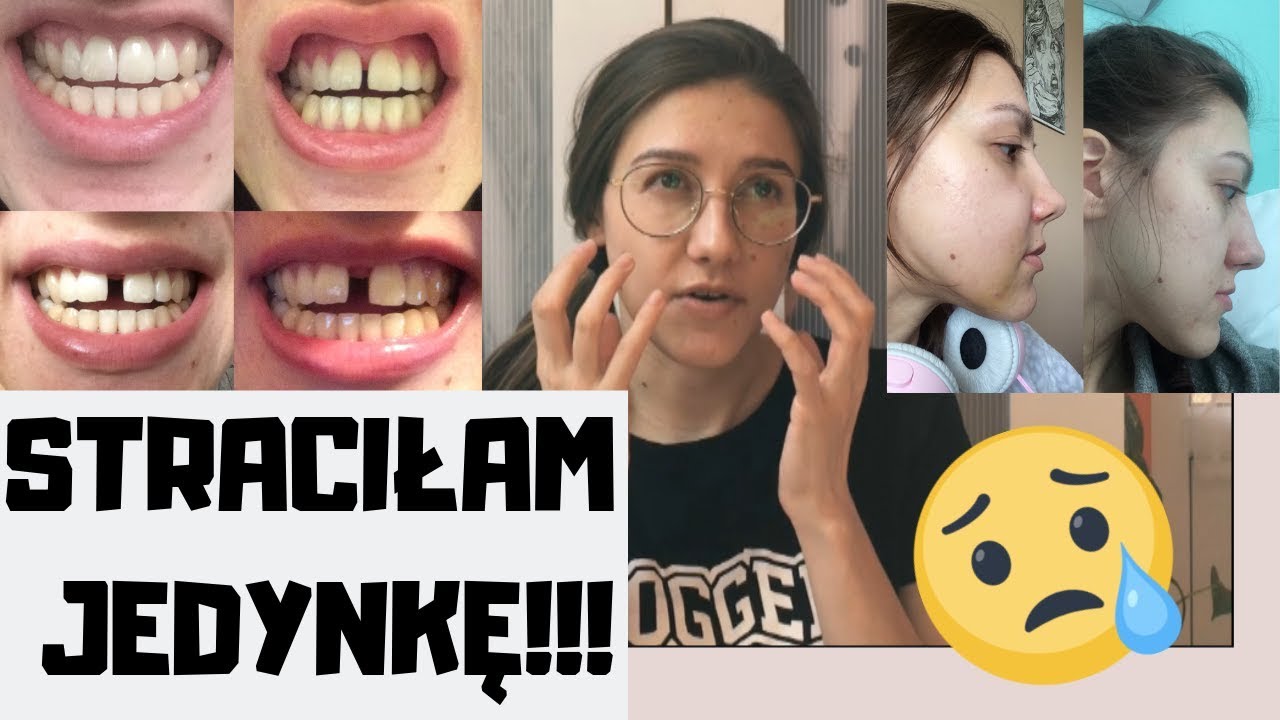 Poszerzenie szczęki / SARPE / SARME / TPD - Moja dystrakcja szczęki #8