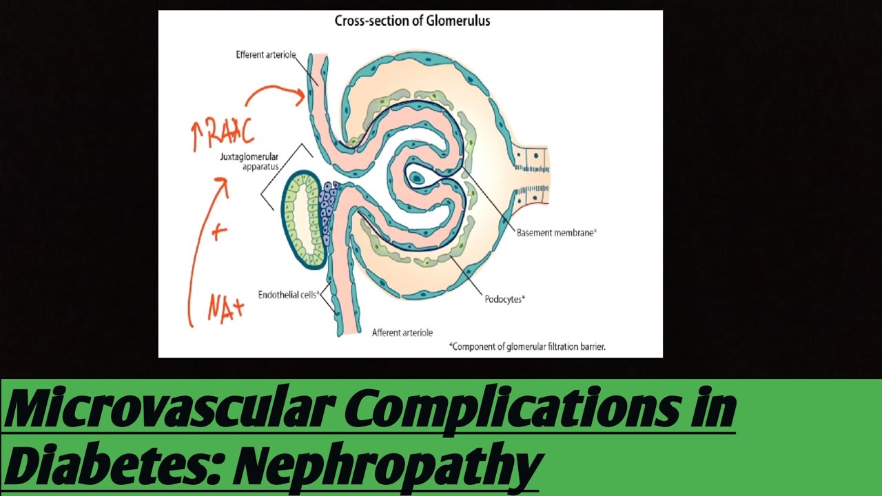 Microvascular Complications in Diabetes: Nephropathy #video