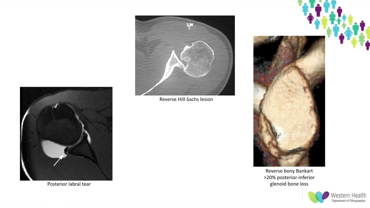 OrthoFracs - Posterior Shoulder Instability by Dr. Phoebe Walker