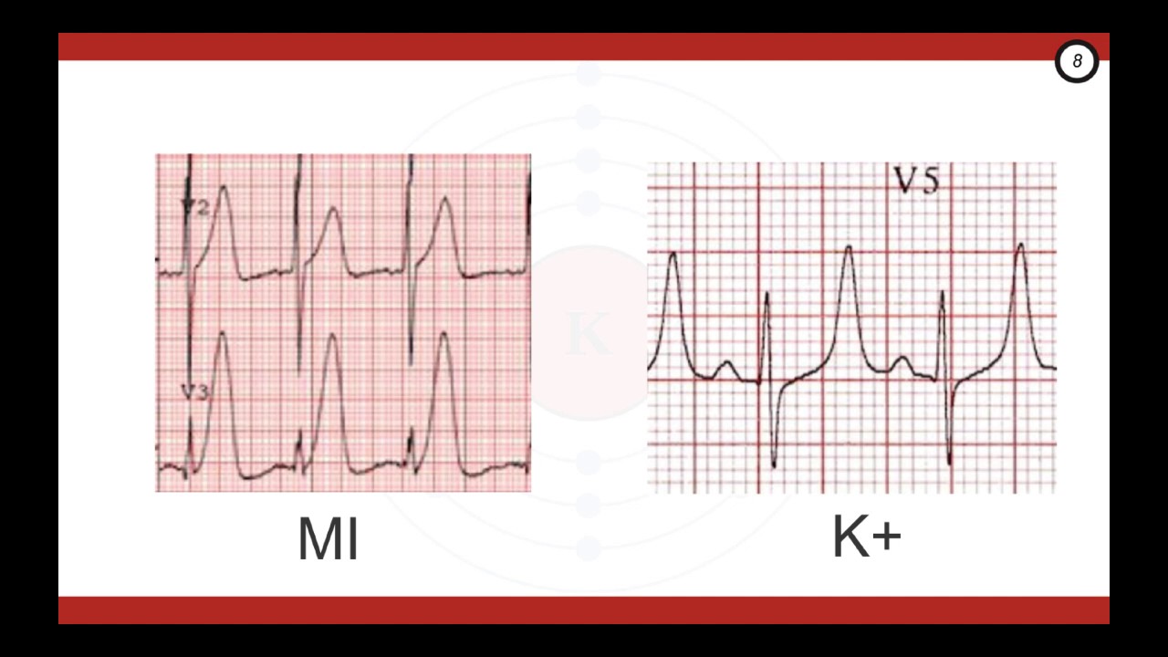 Emergency Management of Hyperkalemia (Part 1)