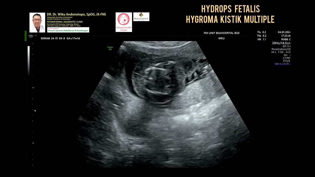 Hydrops Fetalis Hygroma Cystic