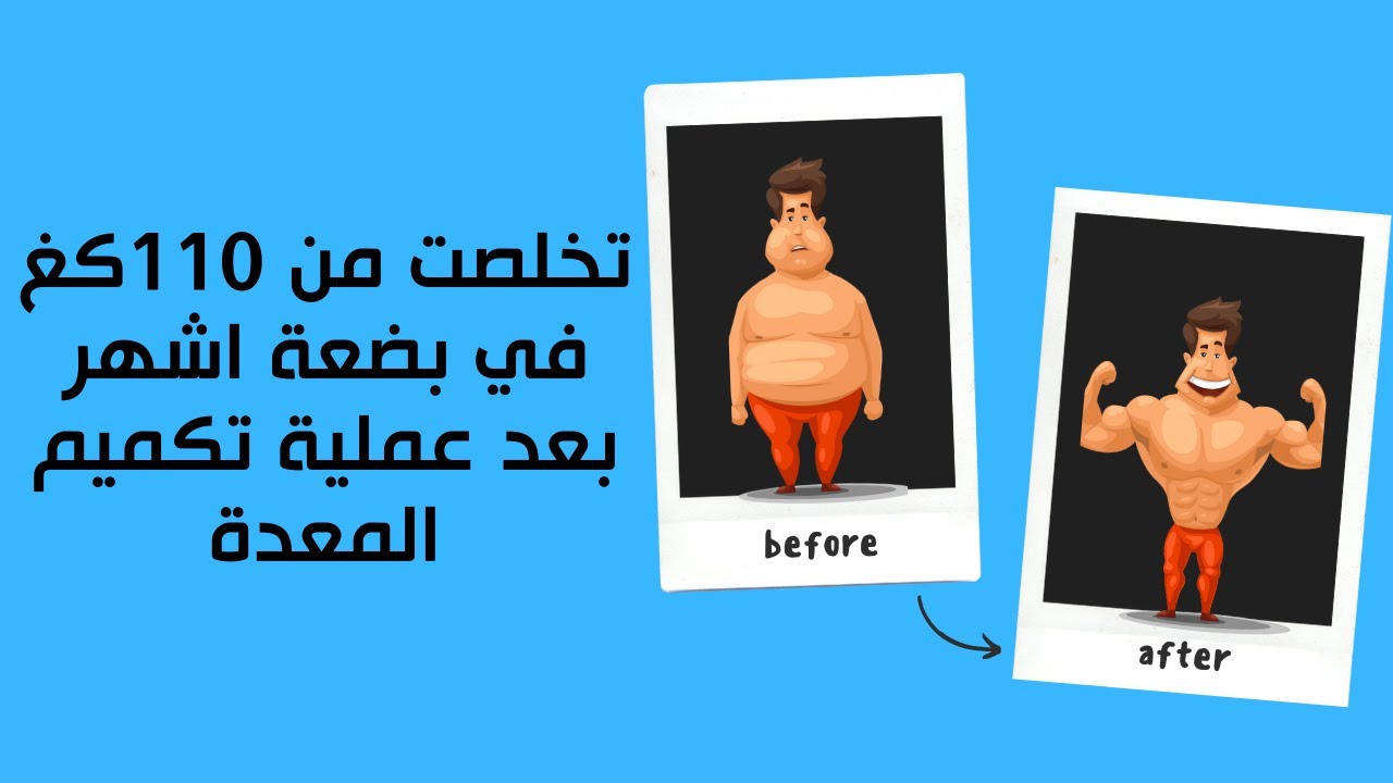 تخلصت من 110كغ  في بضعة اشهر  بعد عملية تكميم المعدة