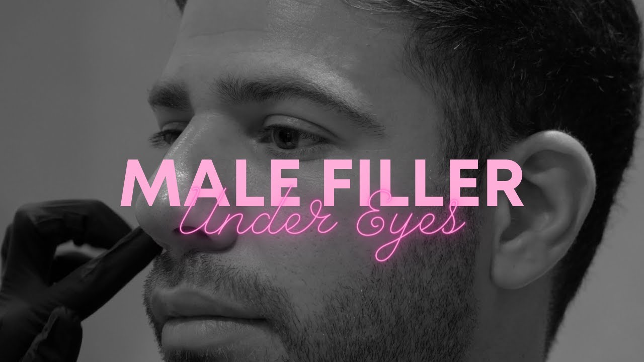 Under Eye Filler For Men | Facial Sculpting Clinic London 💕 Tear Through Filler 1 Year Touch Up