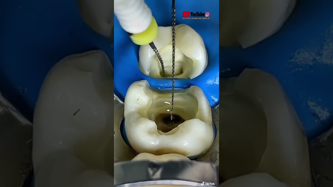 &ldquo;Limas para hacer un  tratamiento de conducto(ENDODONCIA)&rdquo;