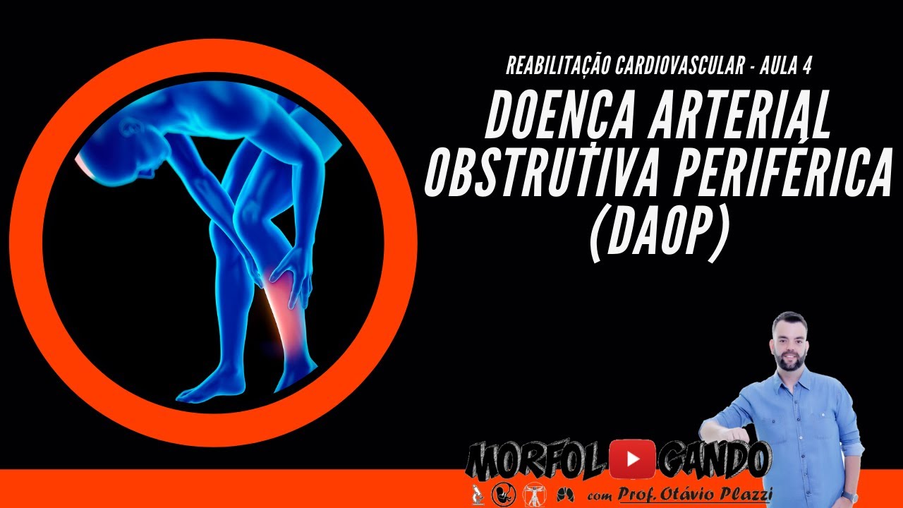 Reabilita&ccedil;&atilde;o Cardiovascular - Aula 4: Doen&ccedil;a Arterial Obstrutiva Cr&ocirc;nica (DAOP) Prof. Ot&aacute;vio Plazzi