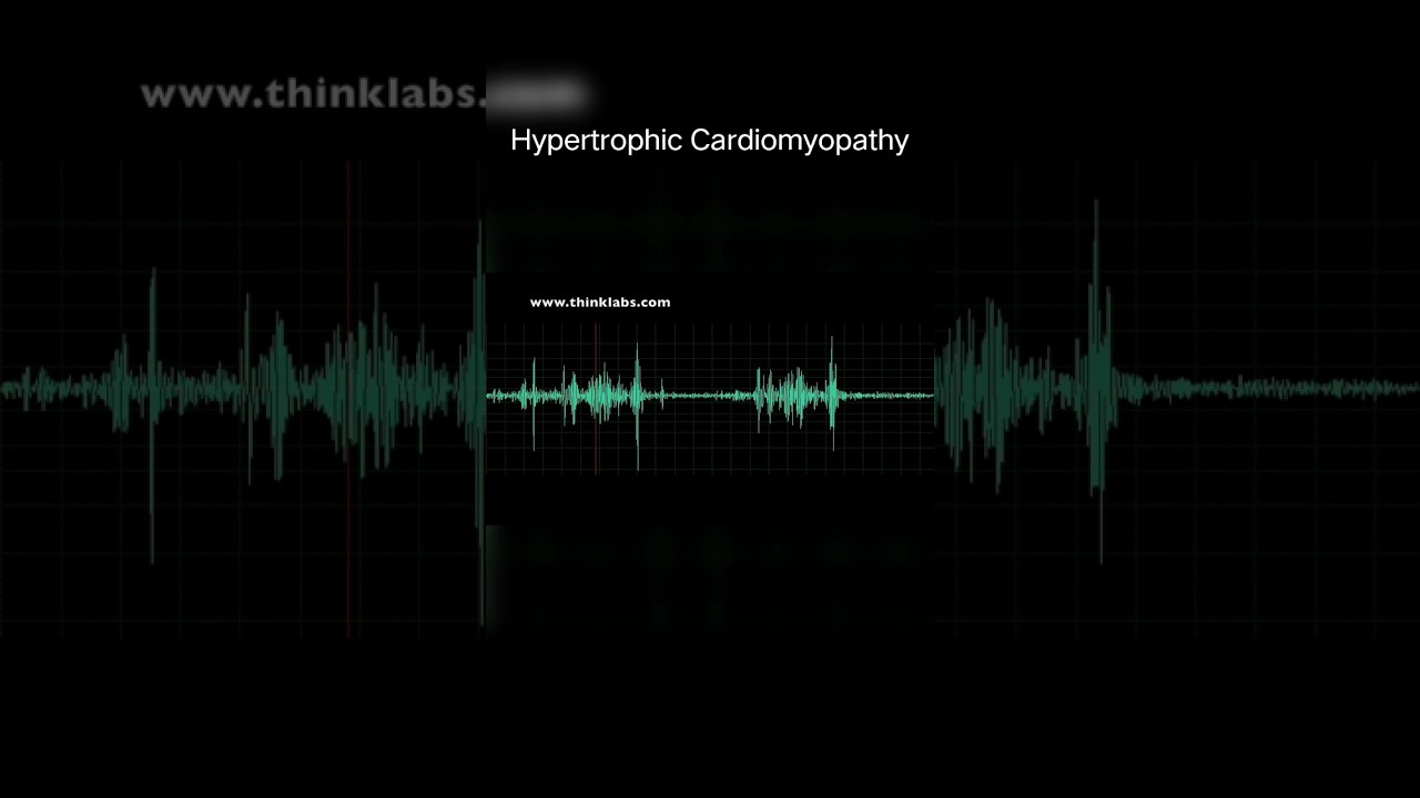 Hypertrophic Cardiomyopathy #medicine #shortsfeed