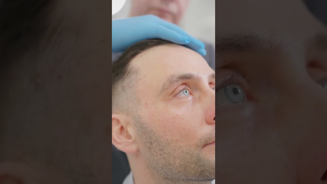 Łysienie androgenowe? Zobacz przeszczep włosów w Klinice HAIR CLINIC SHARLEY dr Paczkowski #shorts