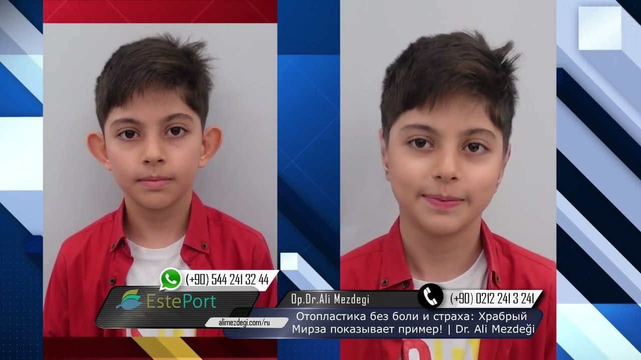 Смотреть всем, кто боится отопластики! 8-летний Мирза показывает пример | Esteport