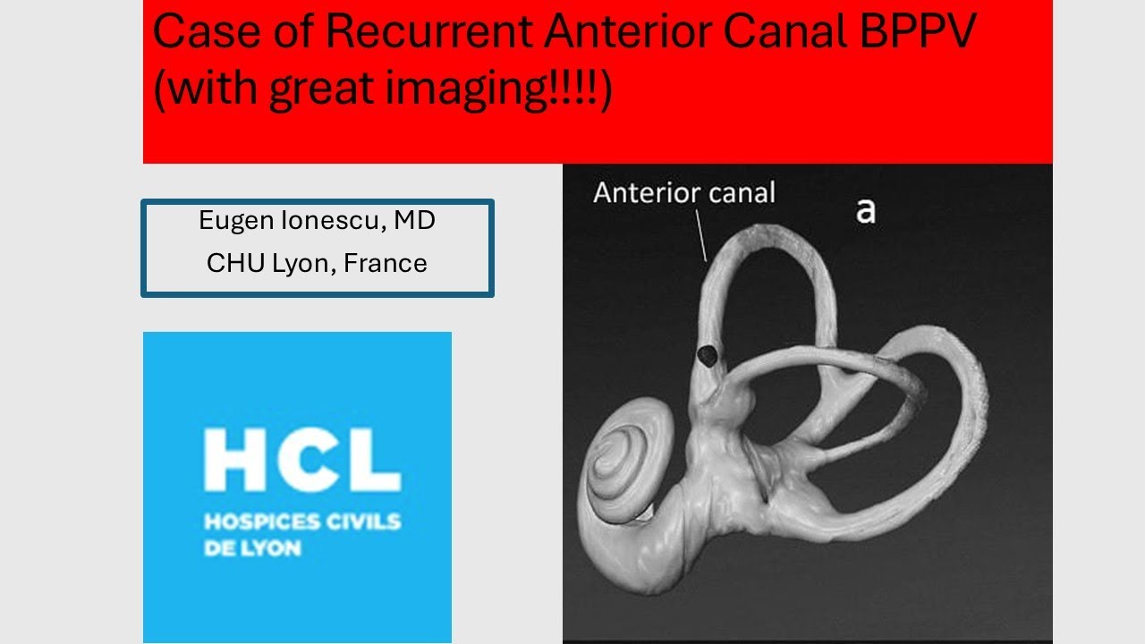 Case 3   Recurrent Anterior Canal BPPV with Great Imaging