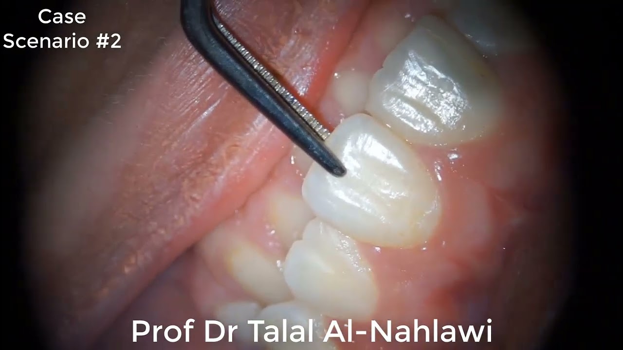 Clinical case scenario in ENDODONTICS BY Prof Dr Talal Al-Nahlawi د. طلال النحلاوي