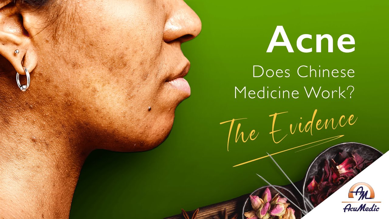 Curing Acne: Is Chinese Medicine the Key to Clear Skin?