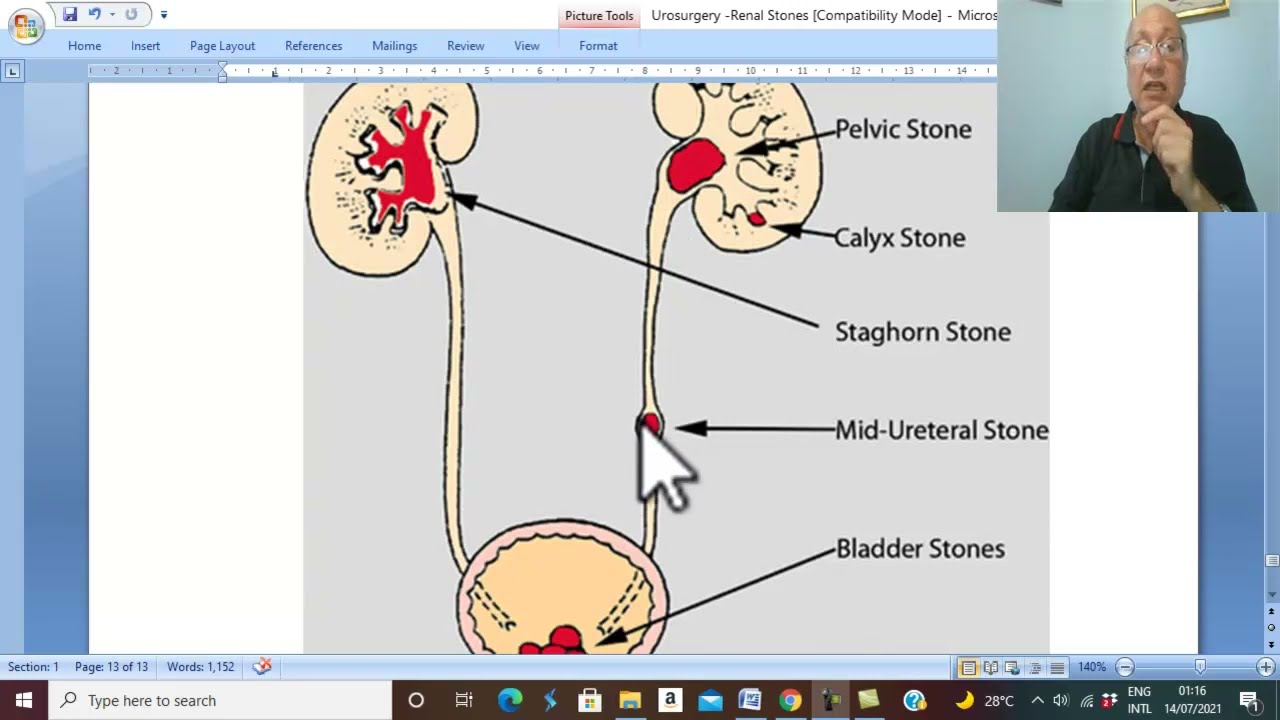 Urosurgery in Arabic 7  (Renal Stones , part 3 ) , by Dr. Wahdan