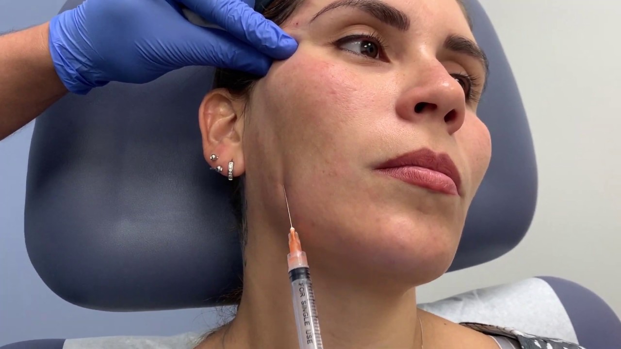 Sculptra treatment for correcting facial volume loss and antiaging by Dr. Shaun Patel in Miami, FL