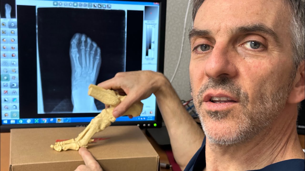 Fit Foot U w/ Dr. Pearl:Sesamoid Stress Reaction in Foot