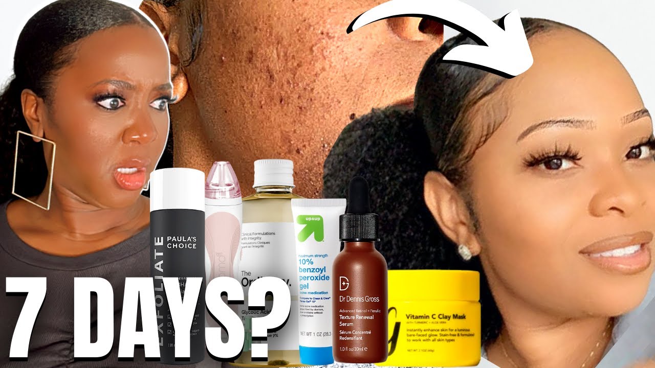 How to Get Clear Skin Fast w/ EXTREME Exfoliation? (Acne & Dark Spots)