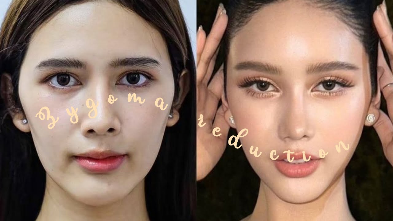 Instant Narrow Face + Zygoma Reduction | Permanent Slim Face & Refined Beauty Sub 🔮
