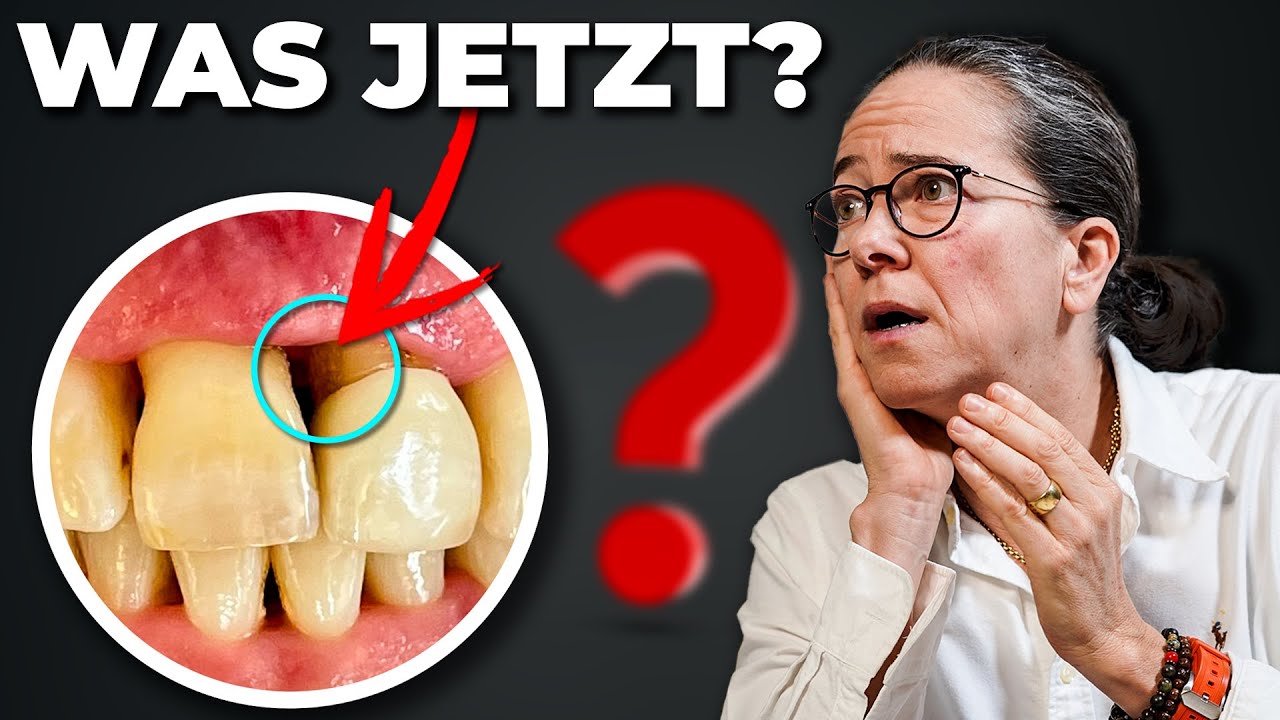 Hilfe- mein Zahnfleisch zieht sich zurück😱 ( oft unbekannte Maßnahmen)
