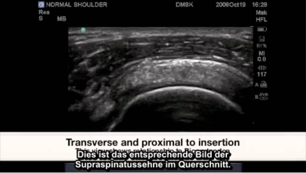 Fallstudie FujiFilm SonoSite: Pathologie der Supraspinatussehne