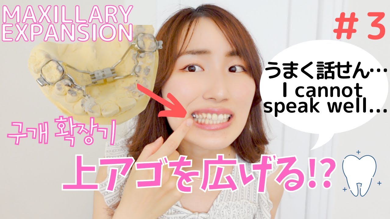 【歯列矯正】上顎急速拡大装置[HYRAX]始めました(JAP/ENG/KOR sub)｜アメリカ生活 #3