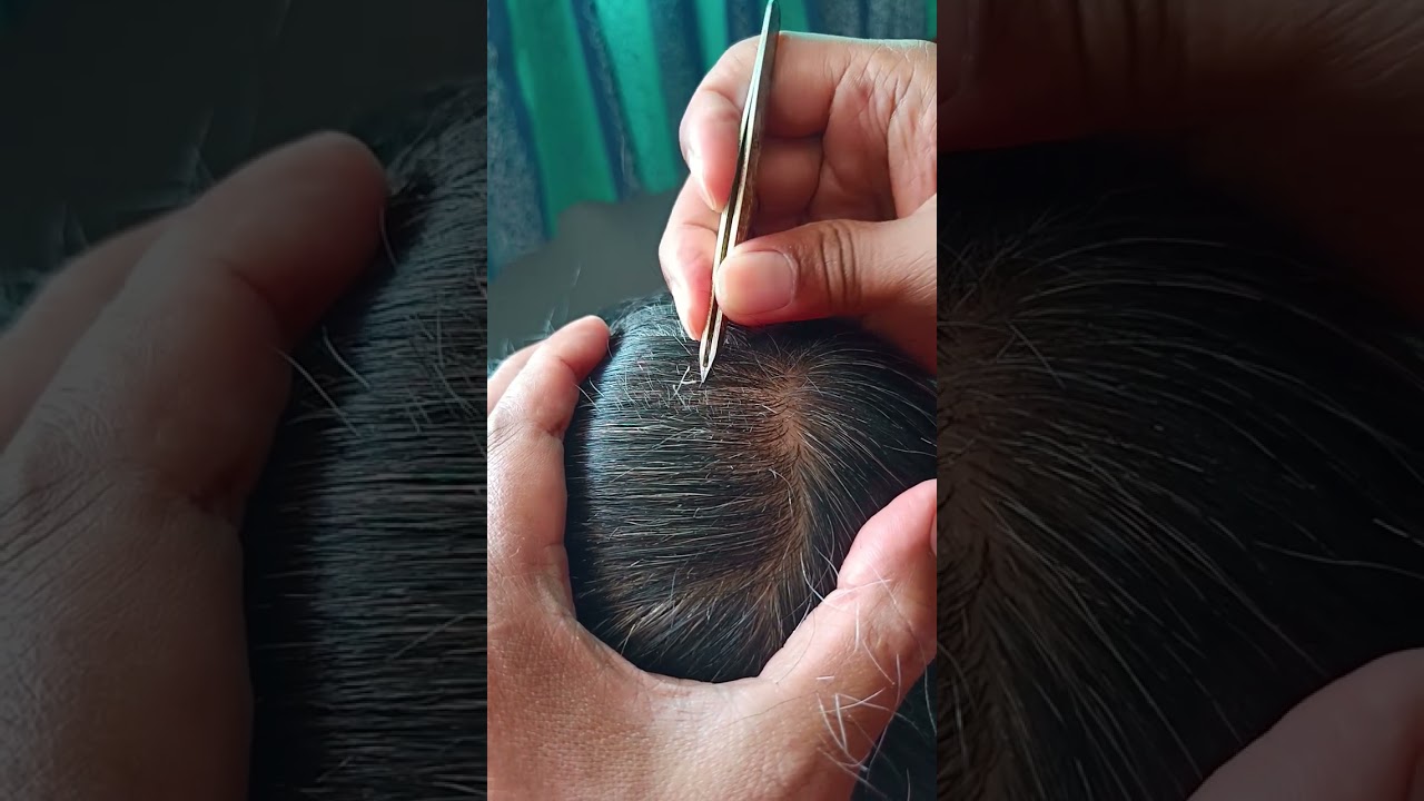 Most satisfying white hair removal 1.39#relaxing #satisfying #stressremoval 
