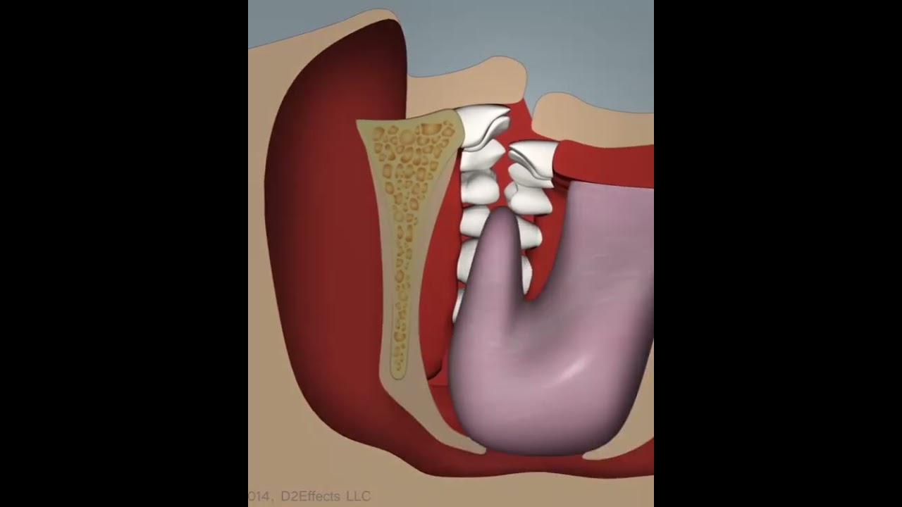Sleep Apnea Causing Tooth Chipping