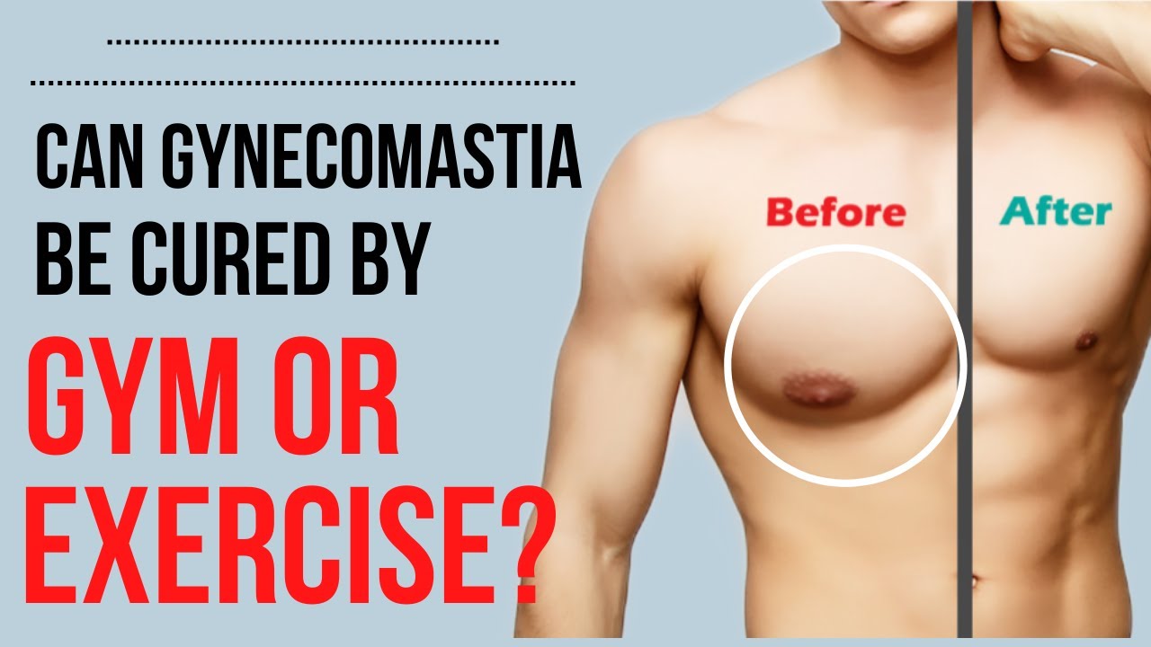 🤔Can Gynecomastia be cured by Gym or Exercise? | Cure Gynecomastia Naturally | Dr. Lokesh Kumar