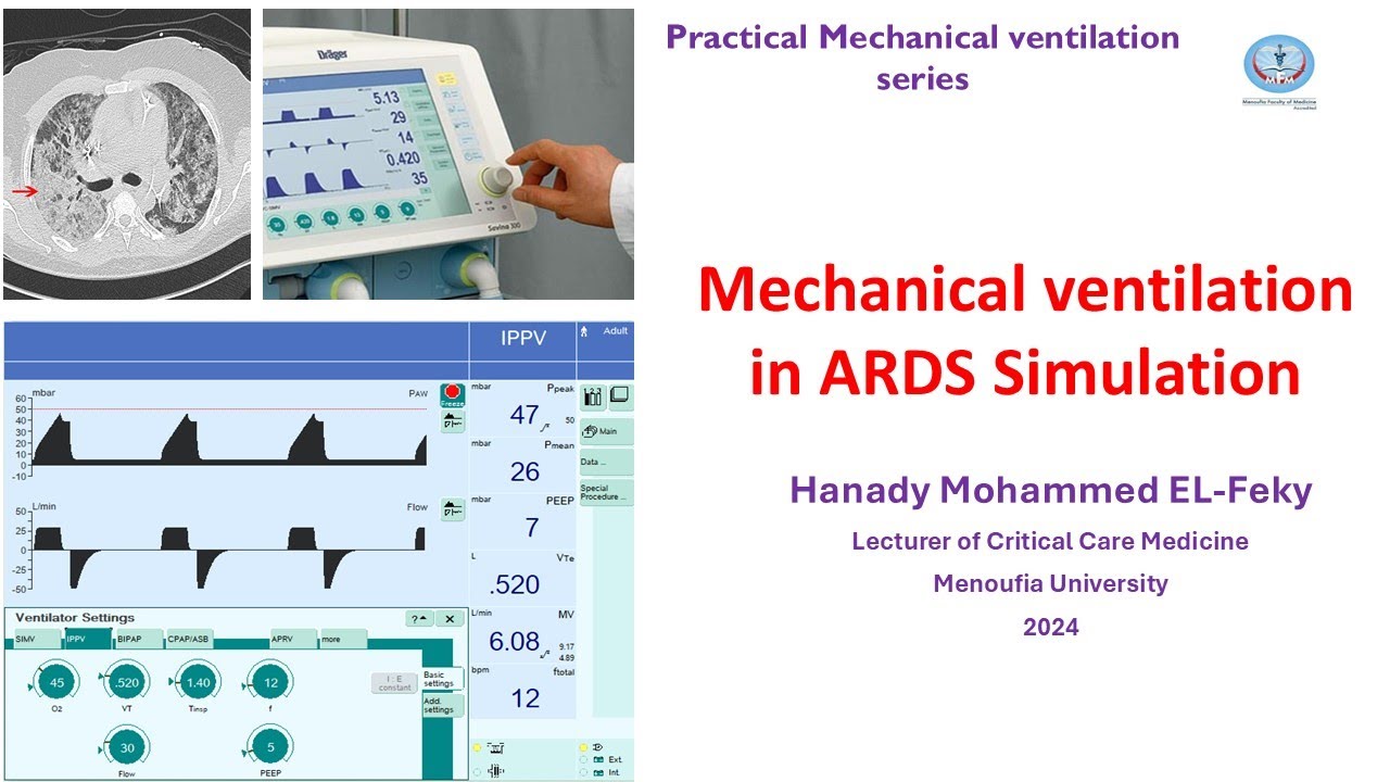 Simulation of Ventilator settings in ARDS in Arabic