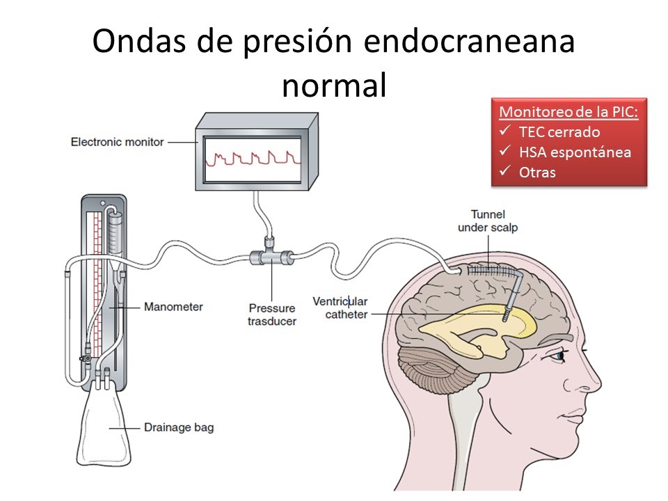 Hipertensión Endocraneana - FISIOPATOLOGIA - GRUPO ATLAS