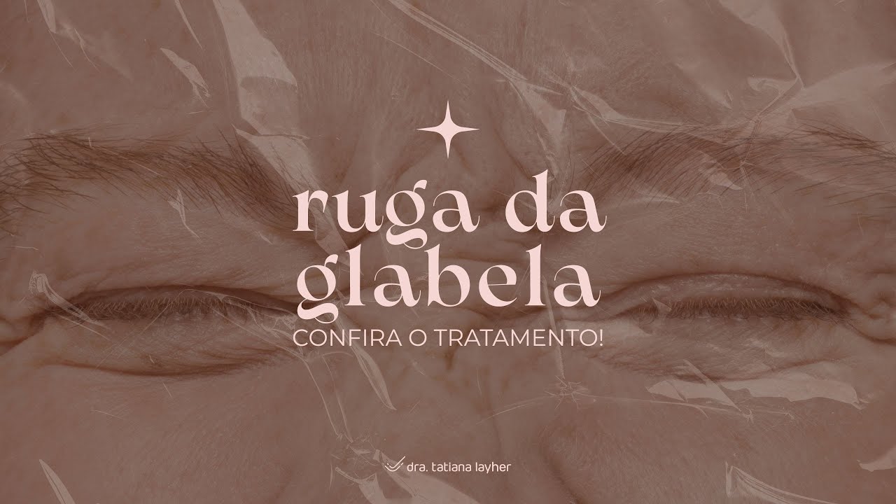 Ruga na Glabela