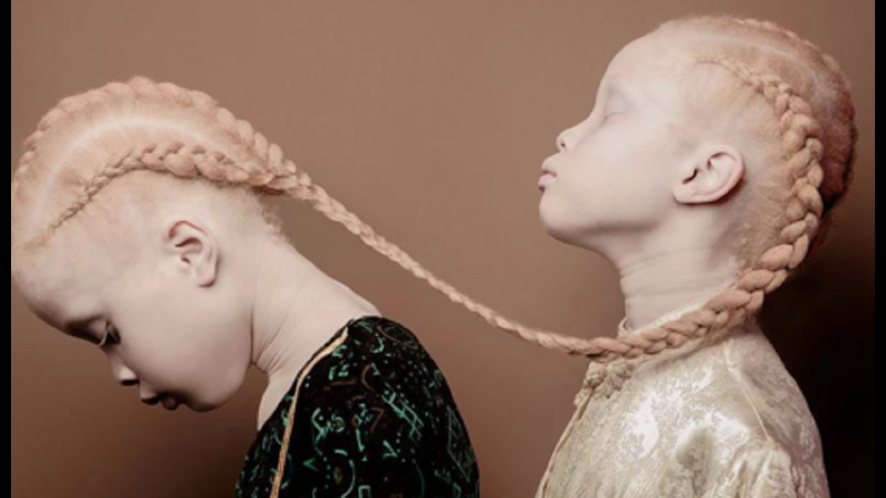 G&ecirc;meas albinas conquistam o mundo da moda com sua beleza &Uacute;nica