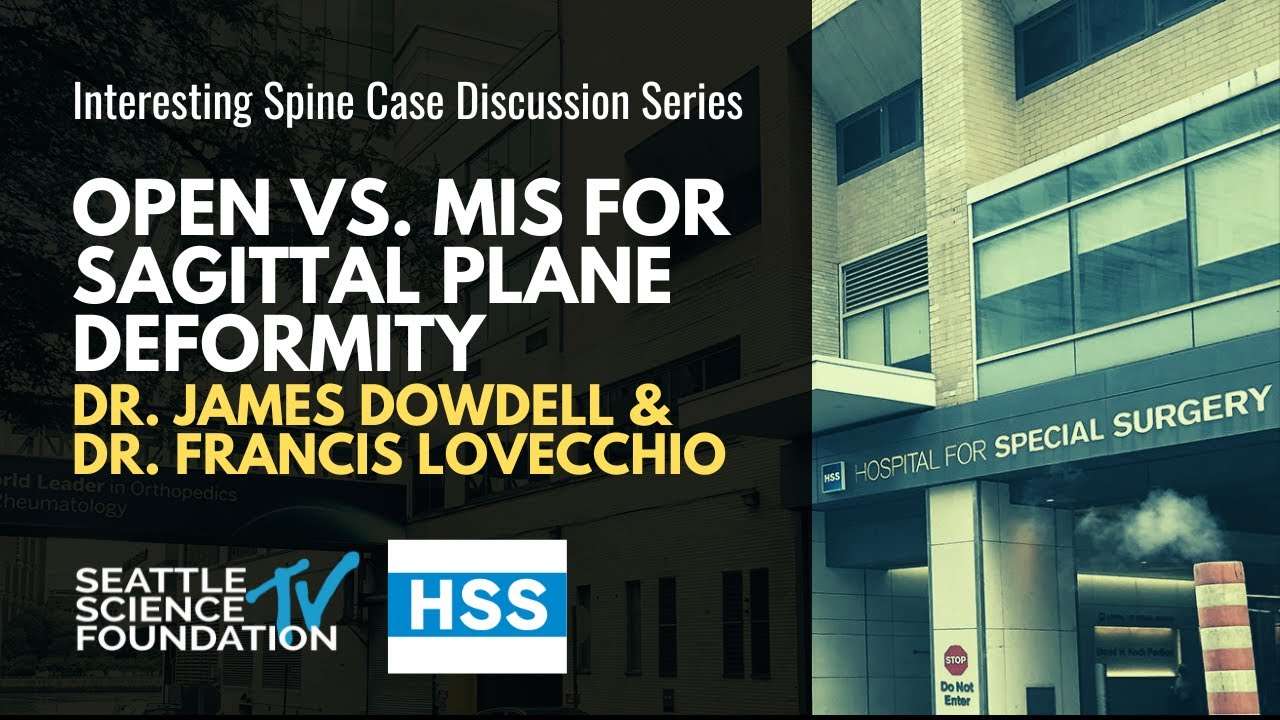 Open vs. MIS For Sagittal Plane Deformity - James Dowdell III, M.D. & Francis C. Lovecchio, M.D.