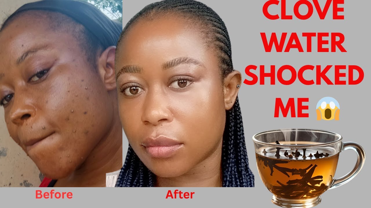 CLOVE WATER CHANGED MY SKIN IN 7 DAYS!