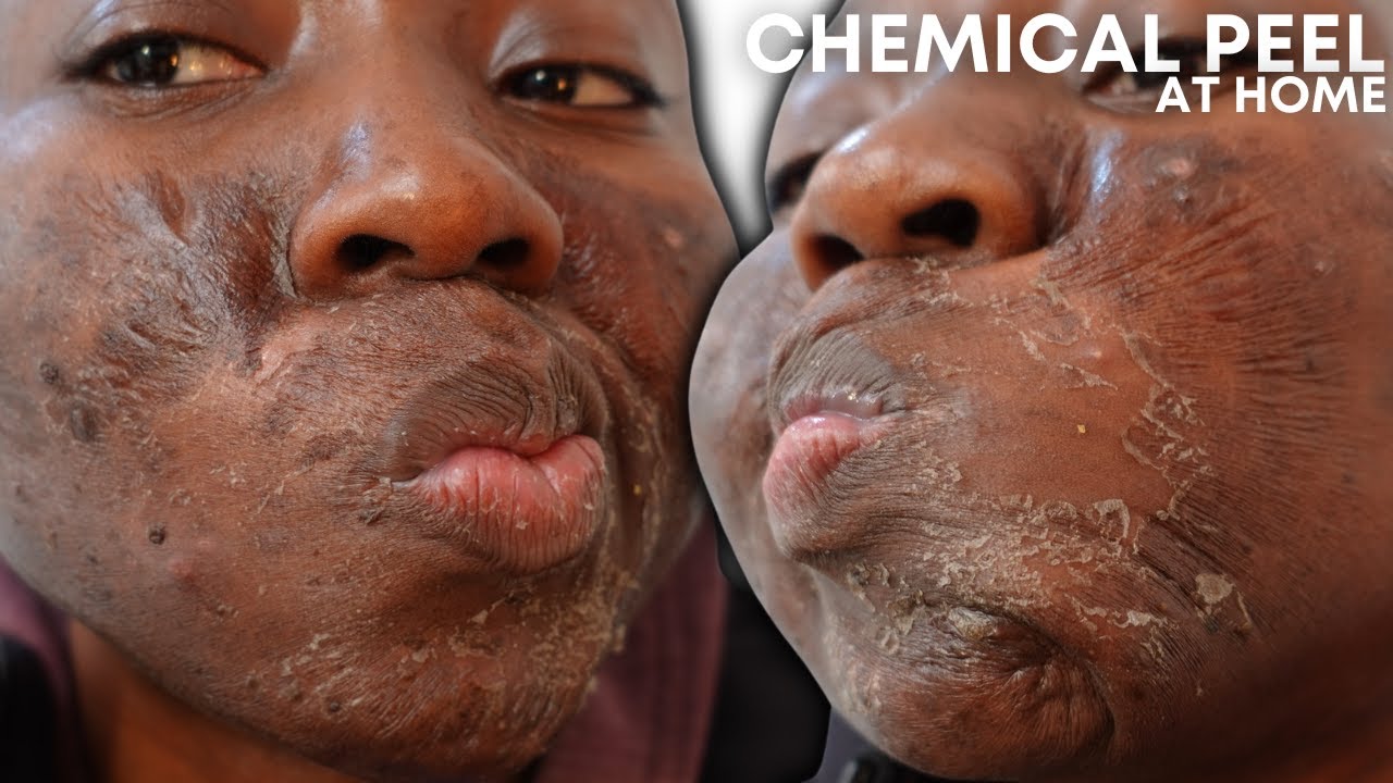 CHEMICAL PEEL FULL PROCESS AT HOME USING JESSNER'S PEEL | BEFORE & AFTER