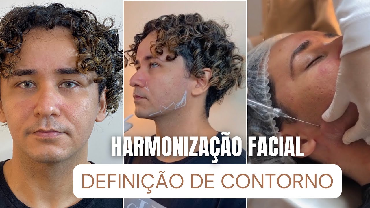 Antes e Depois da Harmonização Facial (Reação Real!)