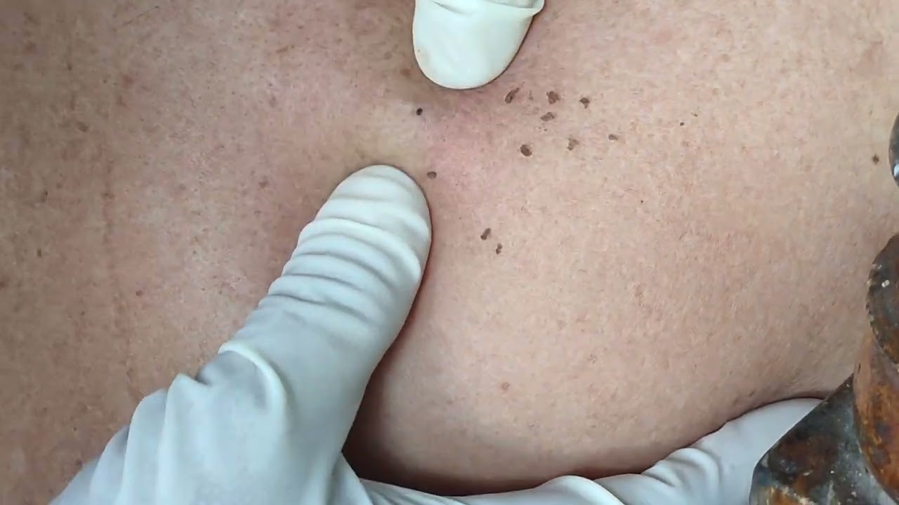 Insane Blackhead Removal on Back! You Won&rsquo;t Believe This 😱