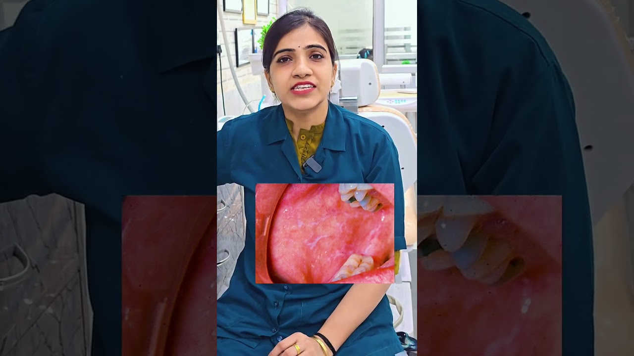 Oral wickhiam striae | diagnostic tool of oral lichen planus #drjyotiagarwal