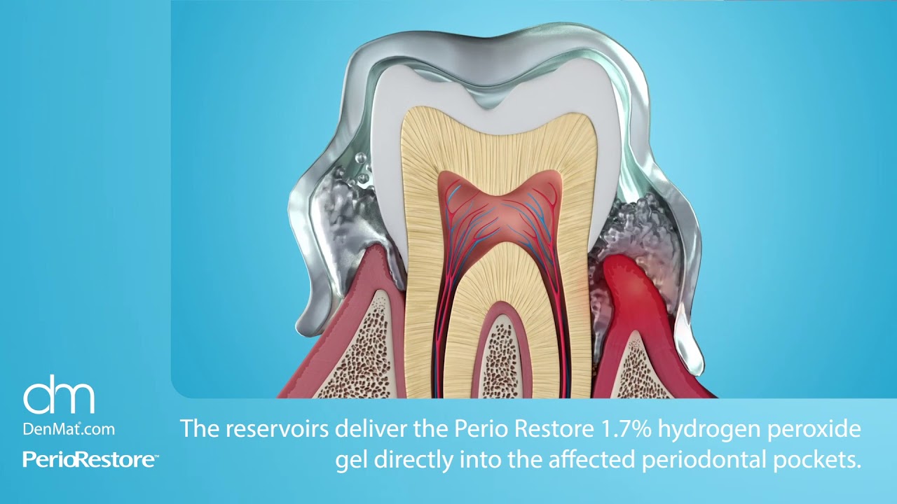 How it Works: Perio Restore&trade; a homecare treatment for periodontal disease - DenMat Dental