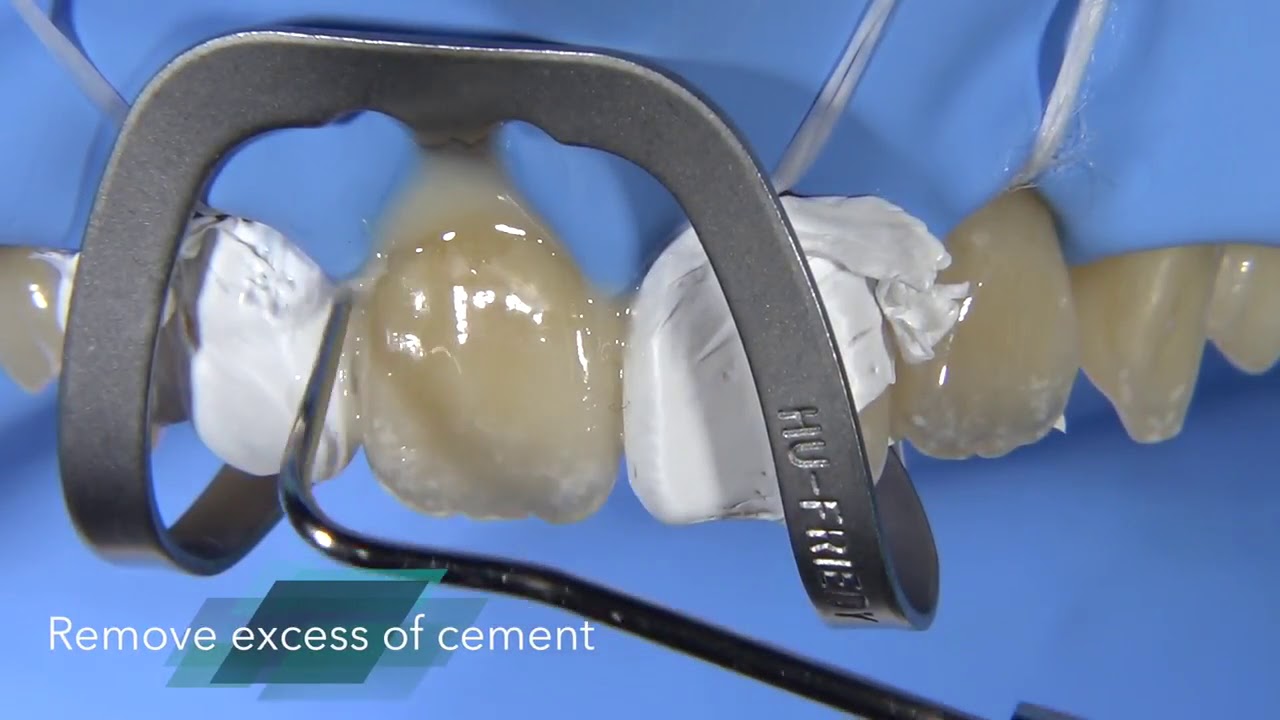 Veneer cementation with the resin cement G_CEM LinkForce
