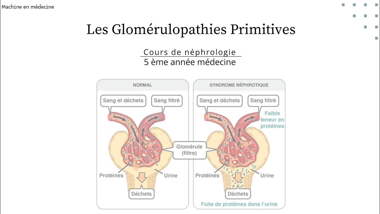 les Glomérulopathies  Primitives ( LGM, HSF, GEM, maladie de BERGER, GNMP, GNRP) #nephro