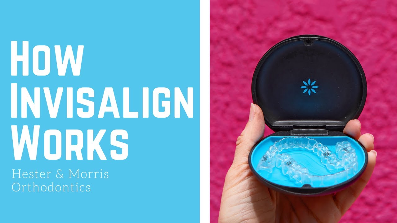 How Invisalign Works