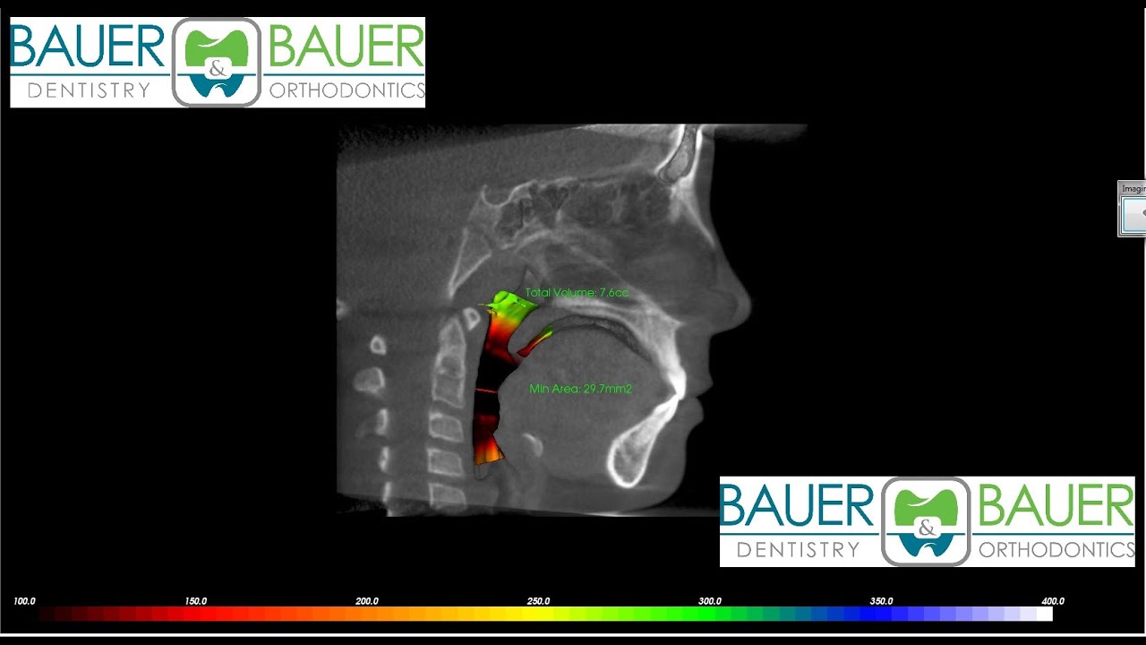 Airway analysis - 3D CBCT with iCAT - Wheaton Orthodontist
