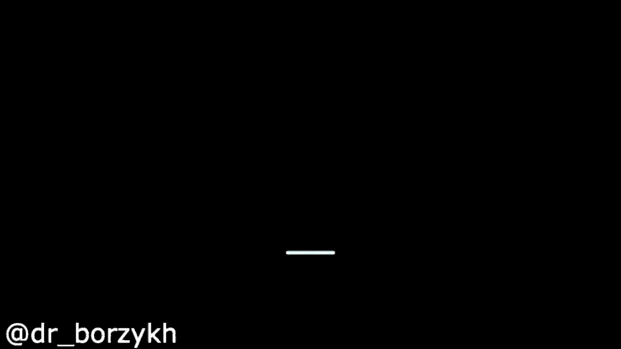 Операция по удалению катаракты с имплантацией ИОЛ B&L Symfony на глазу, осложнённом глаукомой